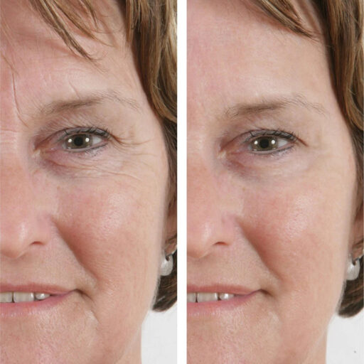 Avis sur Wrinkle Power Filling : Efficacité, sécurité et recommandations dermatologiques