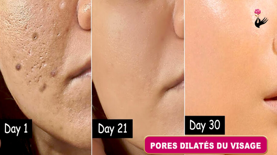 Comment Prendre Soin des Pores Dilatés du Visage Naturellement