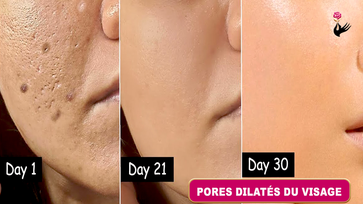 Comment Prendre Soin des Pores Dilatés du Visage Naturellement